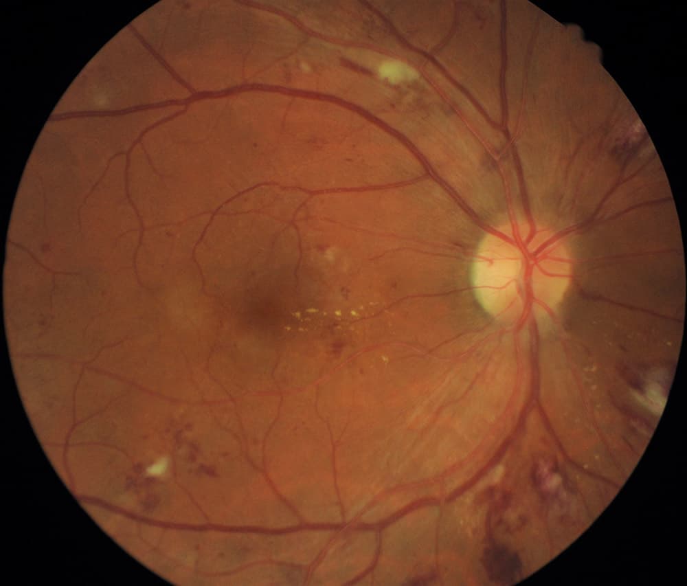 A scan of the retina