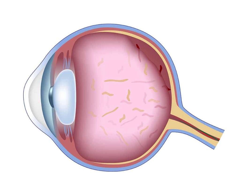 Medical diagram of an eye
