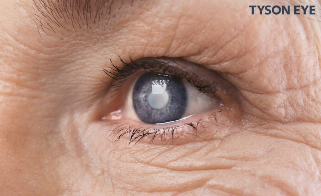 an eyeball showing What is a cataract?